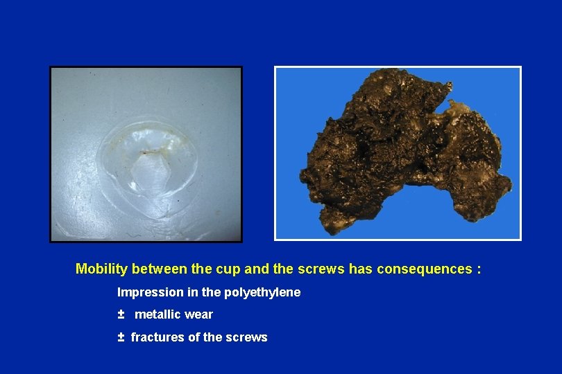Mobility between the cup and the screws has consequences : Impression in the polyethylene