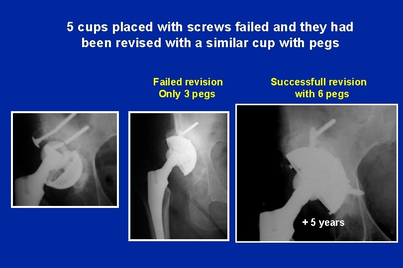 5 cups placed with screws failed and they had been revised with a similar