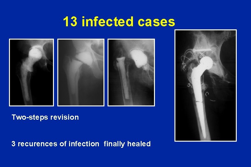 13 infected cases Two-steps revision 3 recurences of infection finally healed 