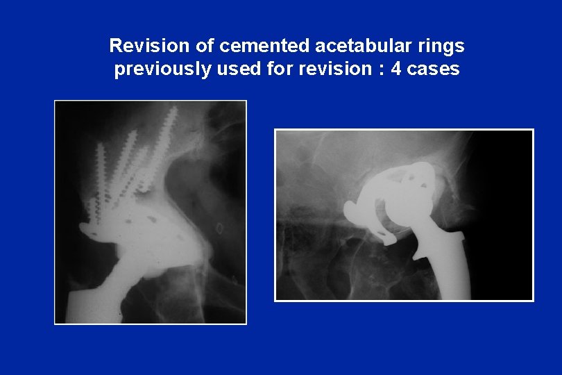 Revision of cemented acetabular rings previously used for revision : 4 cases 