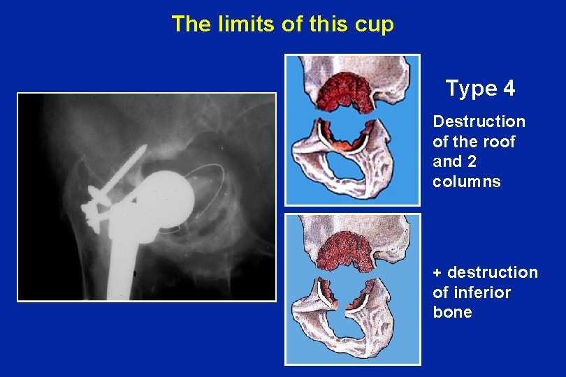 The limits of this cup Type 4 Destruction of the roof and 2 columns