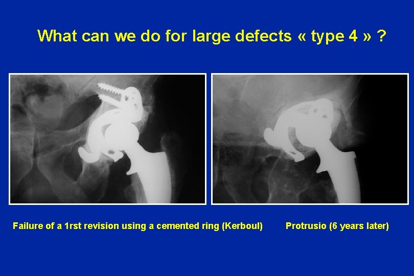 What can we do for large defects « type 4 » ? Failure of