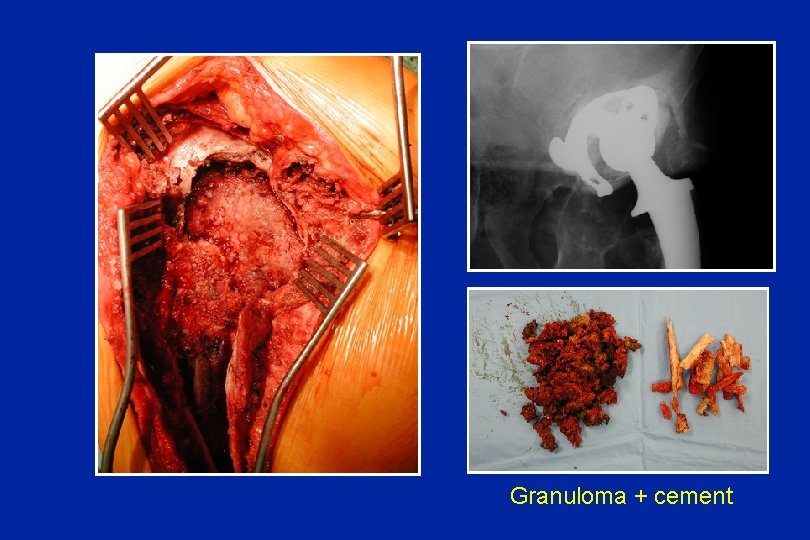 Granuloma + cement 