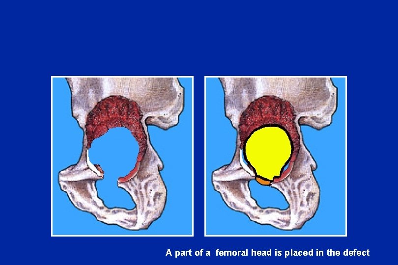 A part of a femoral head is placed in the defect 