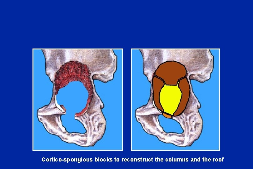 Cortico-spongious blocks to reconstruct the columns and the roof 