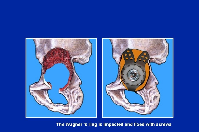 The Wagner ’s ring is impacted and fixed with screws 