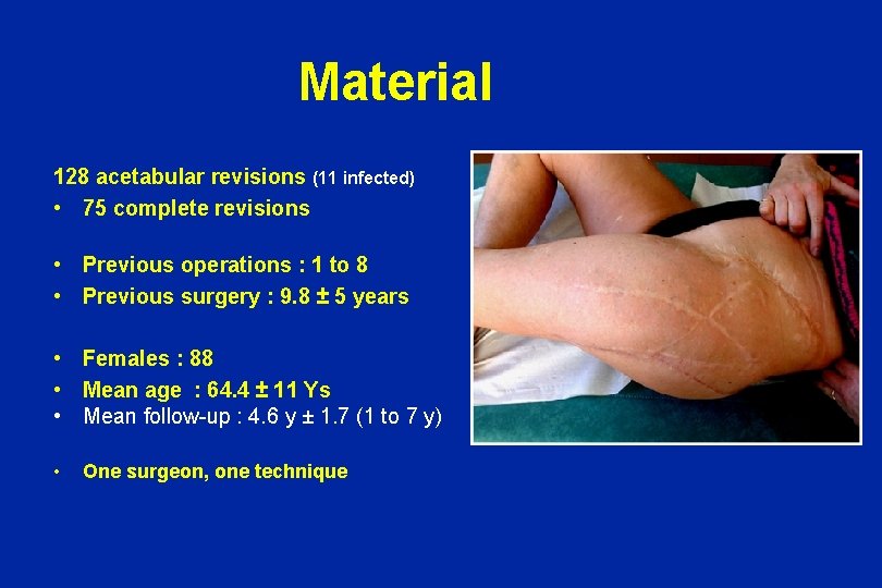 Material 128 acetabular revisions (11 infected) • 75 complete revisions • • • Previous