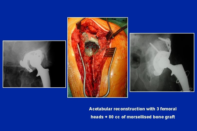 Acetabular reconstruction with 3 femoral heads + 80 cc of morsellised bone graft 