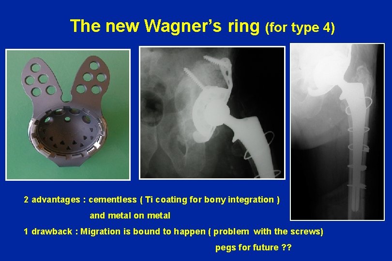  The new Wagner’s ring (for type 4) 2 advantages : cementless ( Ti