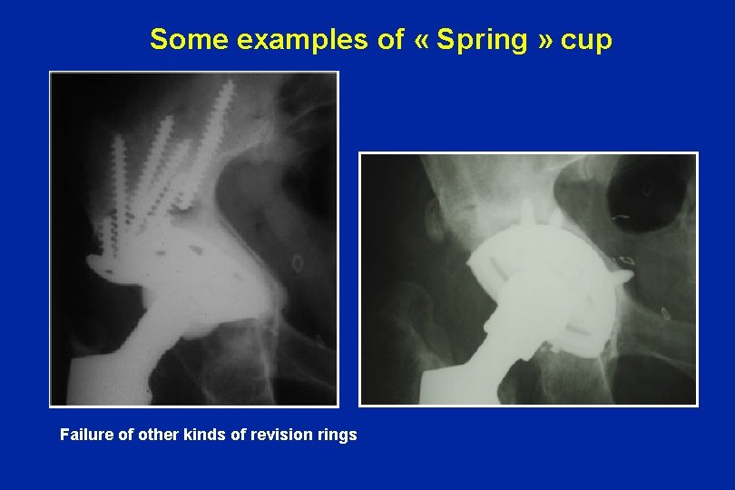 Some examples of « Spring » cup Failure of other kinds of revision rings