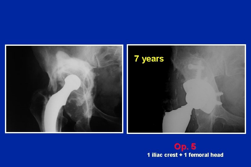 7 years Op. 5 1 iliac crest + 1 femoral head 