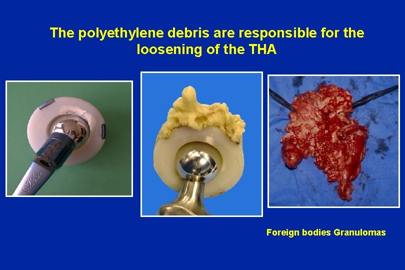 The polyethylene debris are responsible for the loosening of the THA Foreign bodies Granulomas