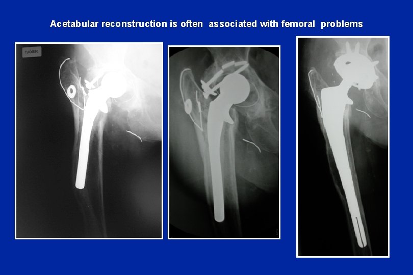 Acetabular reconstruction is often associated with femoral problems 