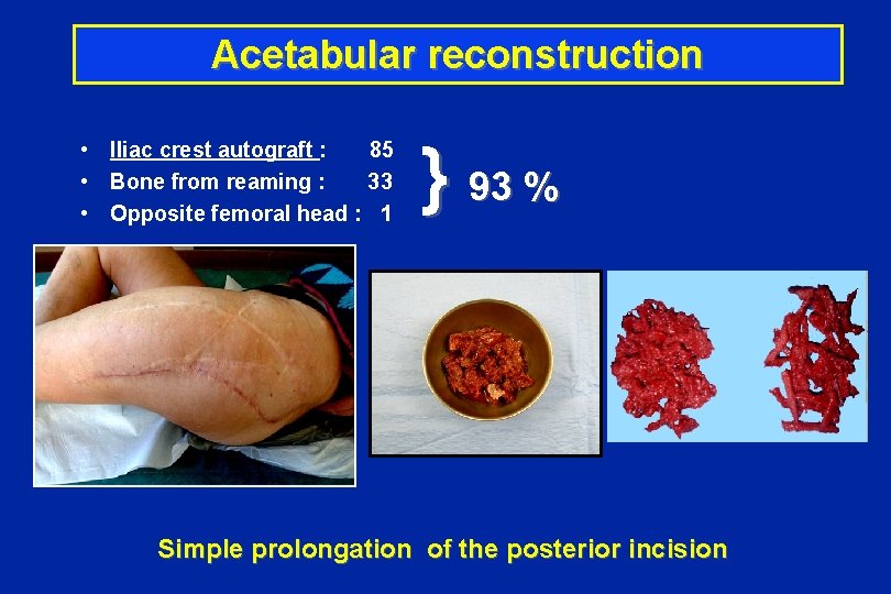 Acetabular reconstruction } 93 % • Iliac crest autograft : 85 • Bone from