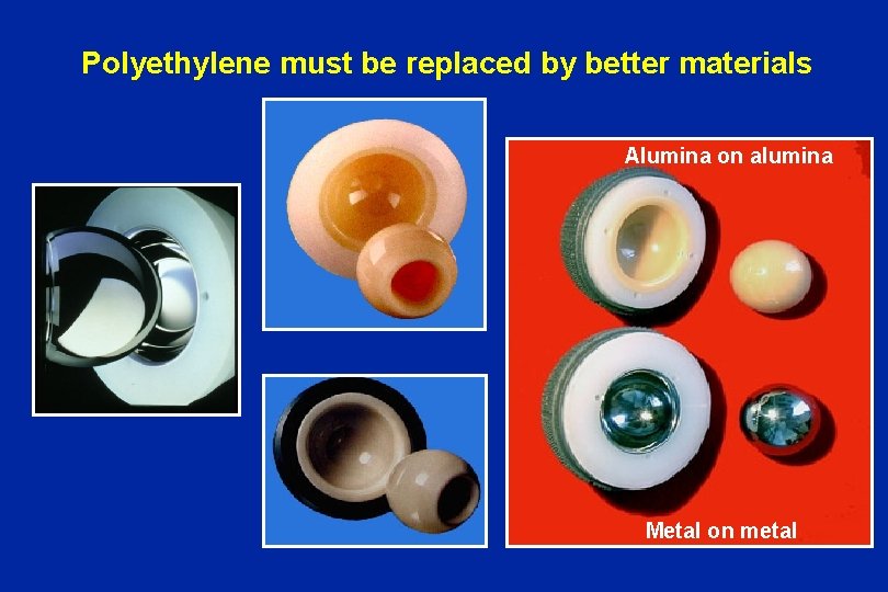 Polyethylene must be replaced by better materials Alumina on alumina Alumine - polyéthylène Alumine