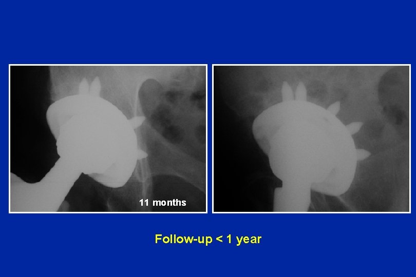 11 months Follow-up < 1 year 