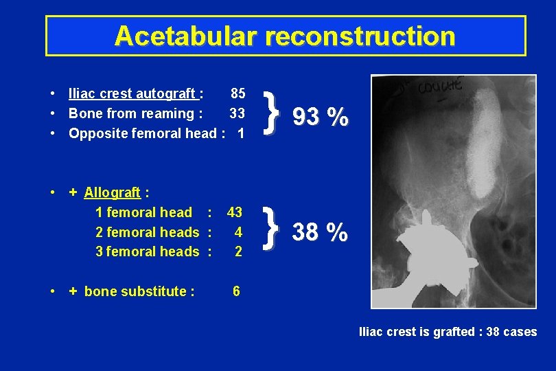 Acetabular reconstruction } 93 % • Iliac crest autograft : 85 • Bone from