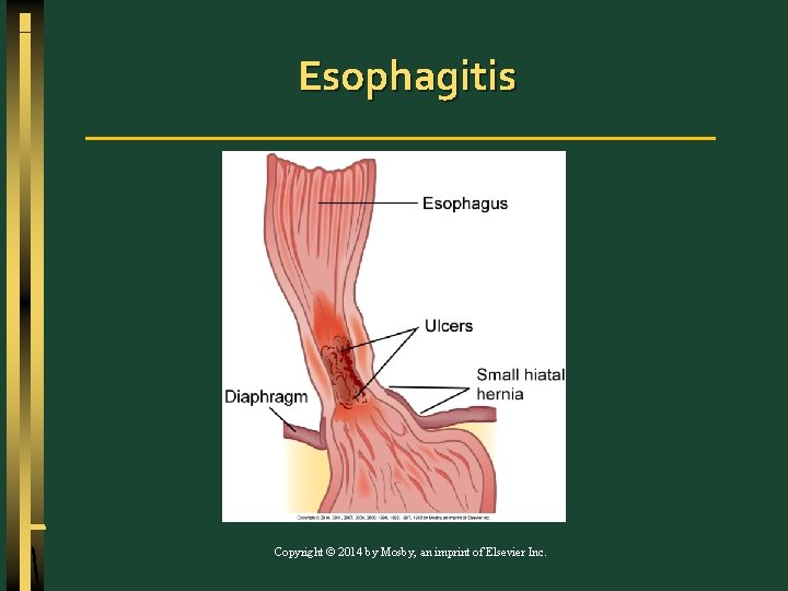 Esophagitis Copyright © 2014 by Mosby, an imprint of Elsevier Inc. 