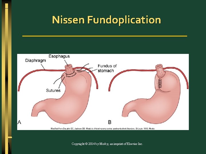 Nissen Fundoplication Copyright © 2014 by Mosby, an imprint of Elsevier Inc. 