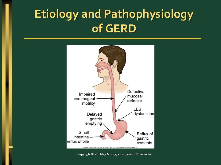 Etiology and Pathophysiology of GERD Copyright © 2014 by Mosby, an imprint of Elsevier