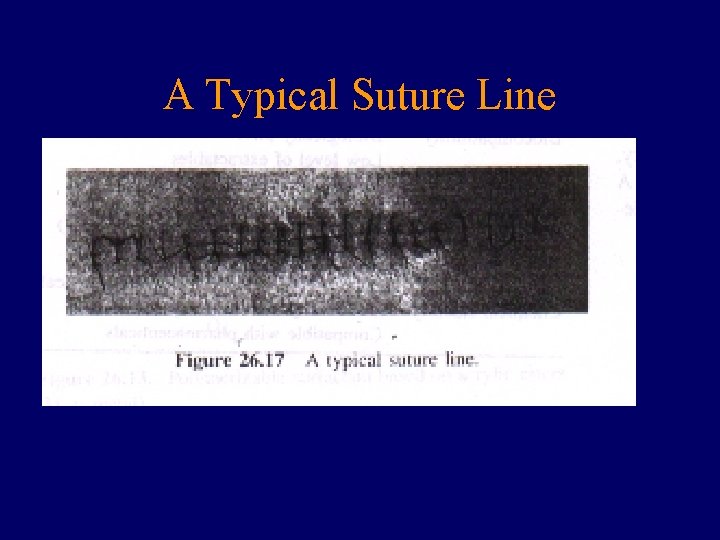 A Typical Suture Line 