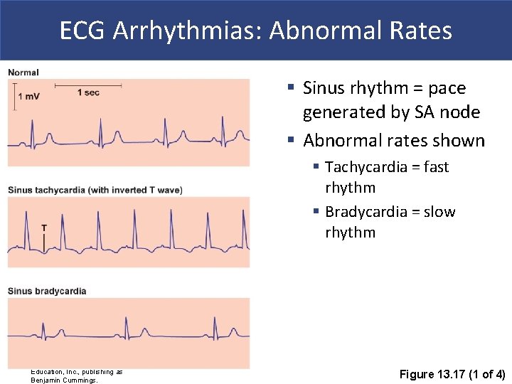 ECG Arrhythmias: Abnormal Rates § Sinus rhythm = pace generated by SA node §