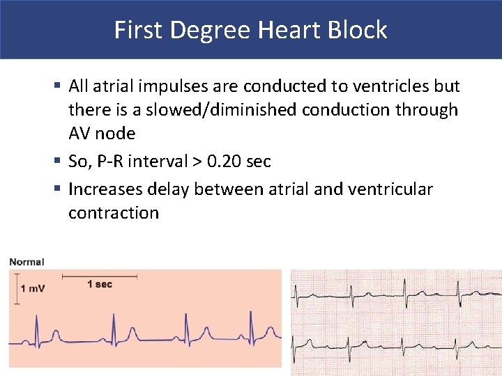 First Degree Heart Block § All atrial impulses are conducted to ventricles but there