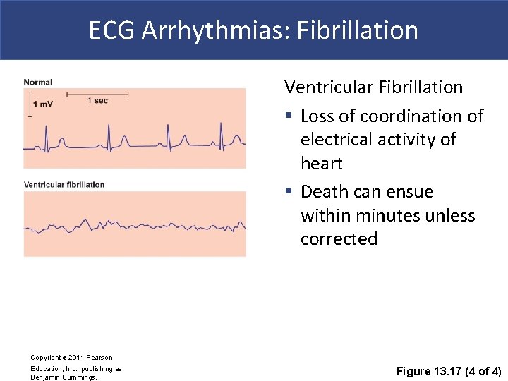 ECG Arrhythmias: Fibrillation Ventricular Fibrillation § Loss of coordination of electrical activity of heart