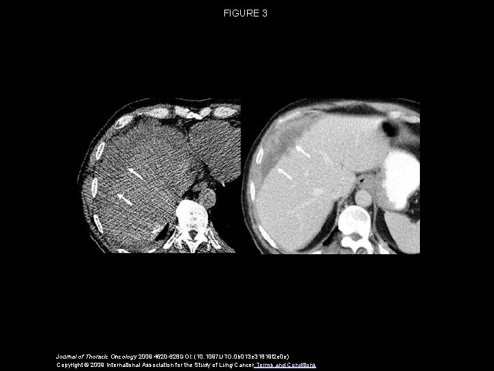 mesothelioma oplucnej