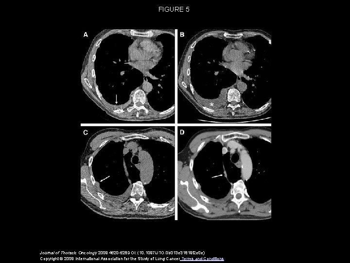 what are early signs of mesothelioma