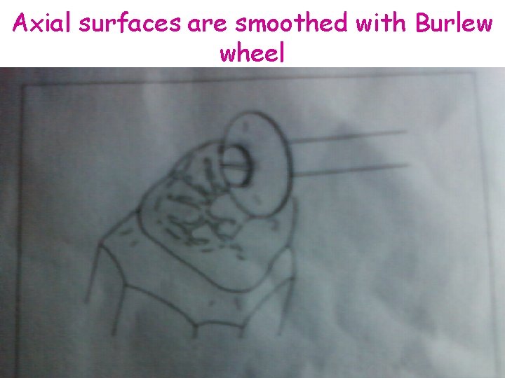 Axial surfaces are smoothed with Burlew wheel 