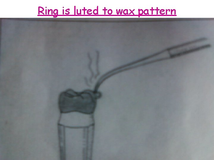 Ring is luted to wax pattern 