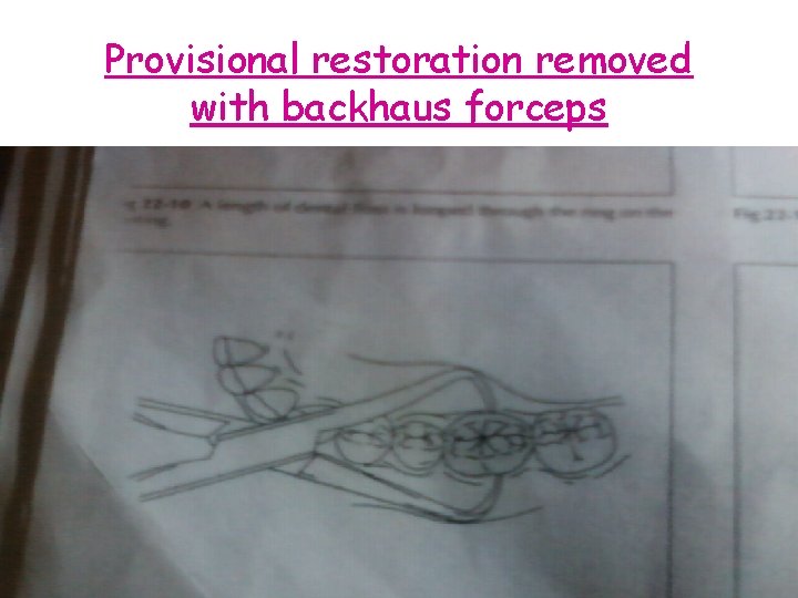 Provisional restoration removed with backhaus forceps 