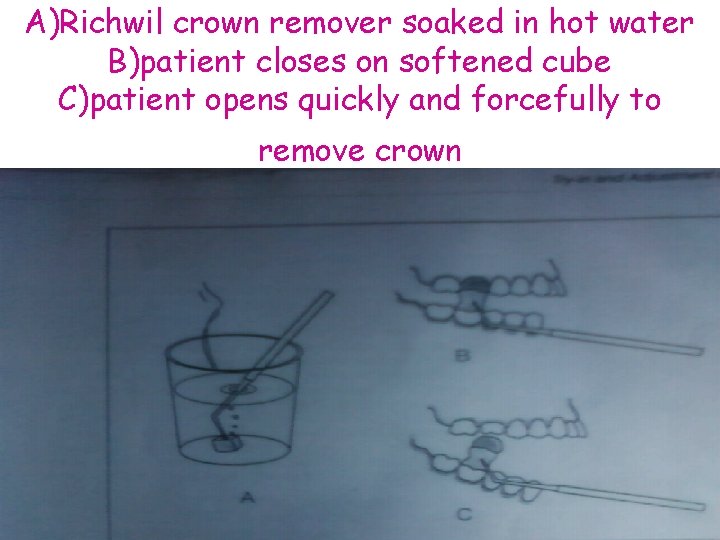 A)Richwil crown remover soaked in hot water B)patient closes on softened cube C)patient opens