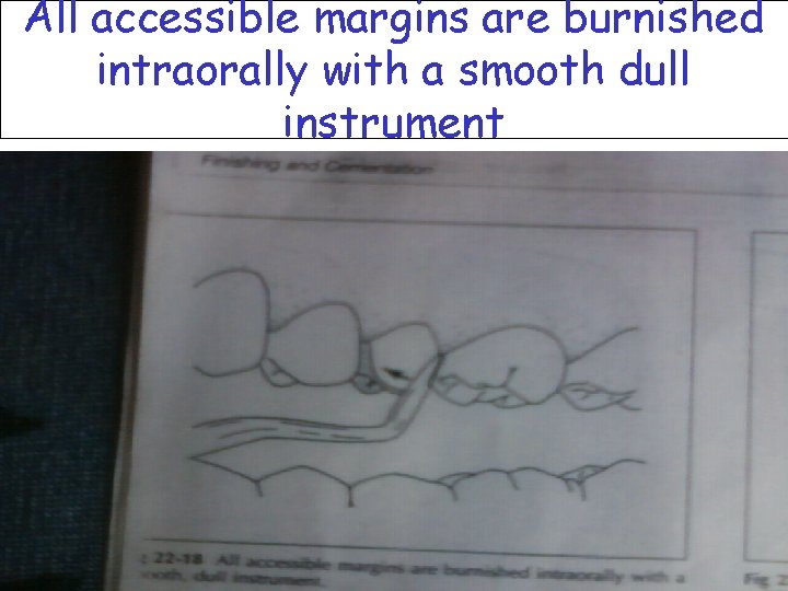 All accessible margins are burnished intraorally with a smooth dull instrument 