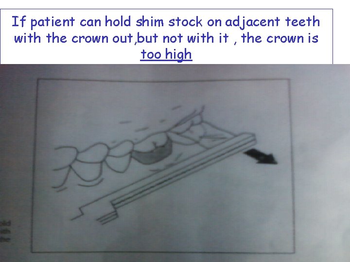 If patient can hold shim stock on adjacent teeth with the crown out, but