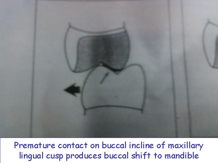 Premature contact on buccal incline of maxillary lingual cusp produces buccal shift to mandible