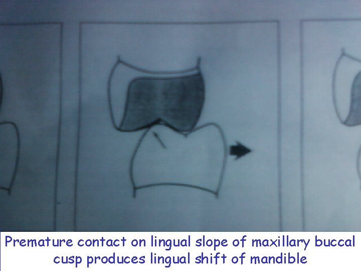 Premature contact on lingual slope of maxillary buccal cusp produces lingual shift of mandible