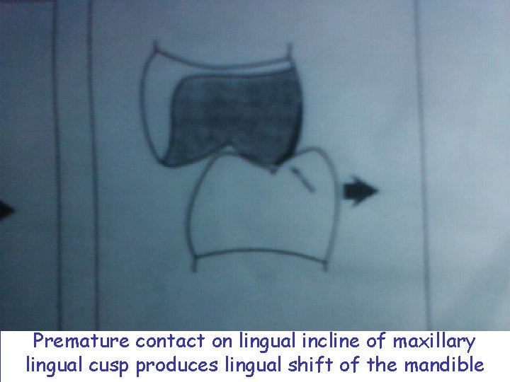 Premature contact on lingual incline of maxillary lingual cusp produces lingual shift of the