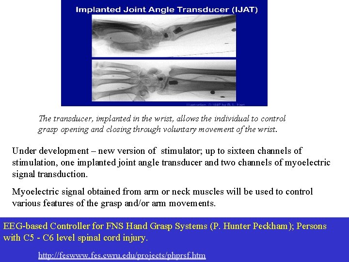 The transducer, implanted in the wrist, allows the individual to control grasp opening and The transducer, implanted in the wrist, allows the individual to control grasp opening and