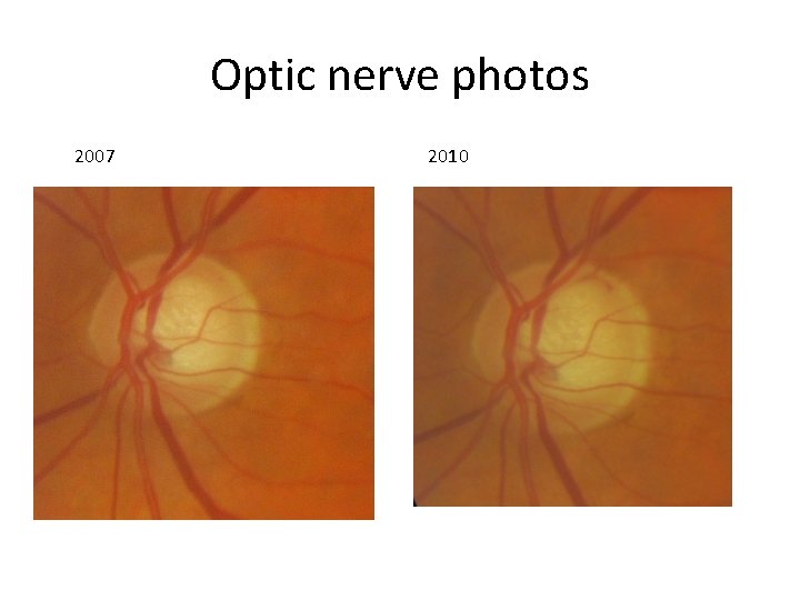 Optic nerve photos 2007 2010 
