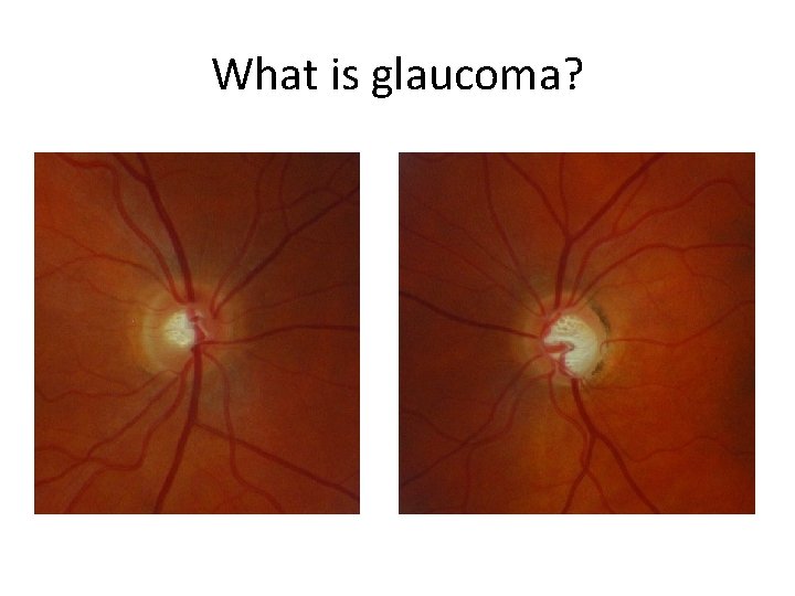 What is glaucoma? 