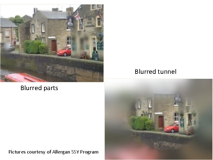 Blurred tunnel Blurred parts Pictures courtesy of Allergan SSY Program 