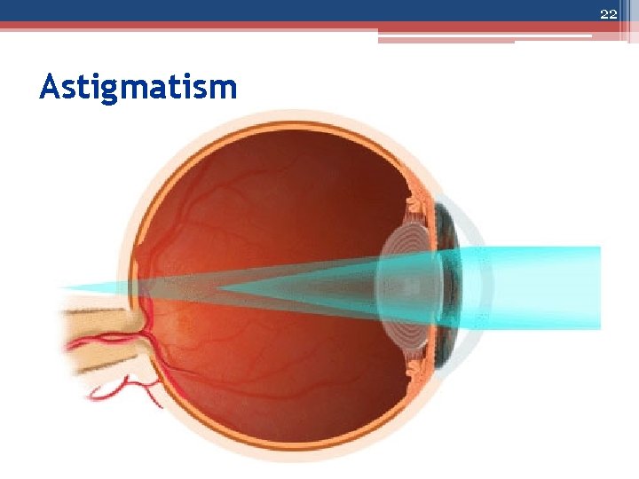 22 Astigmatism 