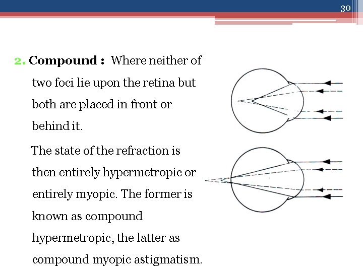 30 2. Compound : Where neither of two foci lie upon the retina but
