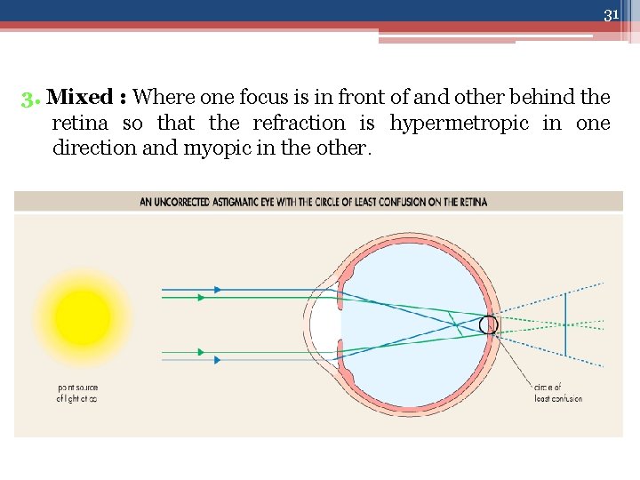 31 3. Mixed : Where one focus is in front of and other behind