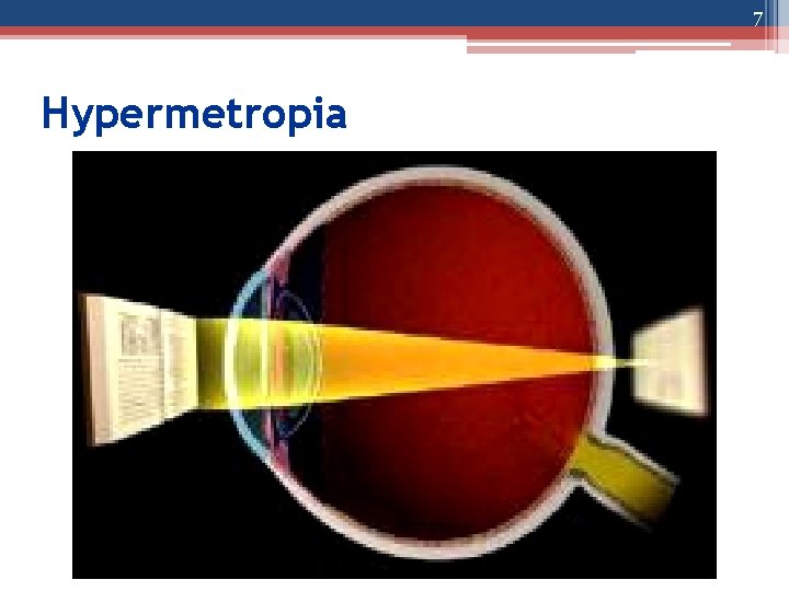 7 Hypermetropia 