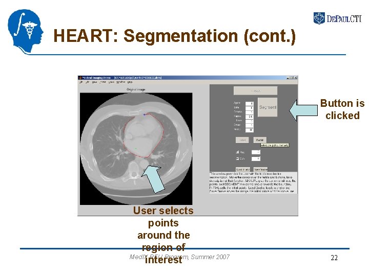 HEART: Segmentation (cont. ) Button is clicked User selects points around the region of