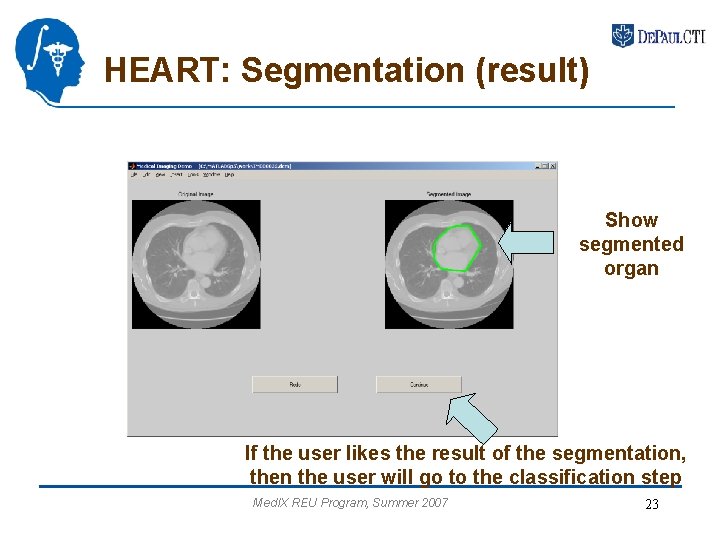 HEART: Segmentation (result) Show segmented organ If the user likes the result of the