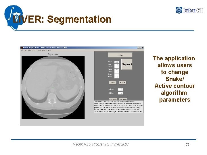 LIVER: Segmentation The application allows users to change Snake/ Active contour algorithm parameters Med.
